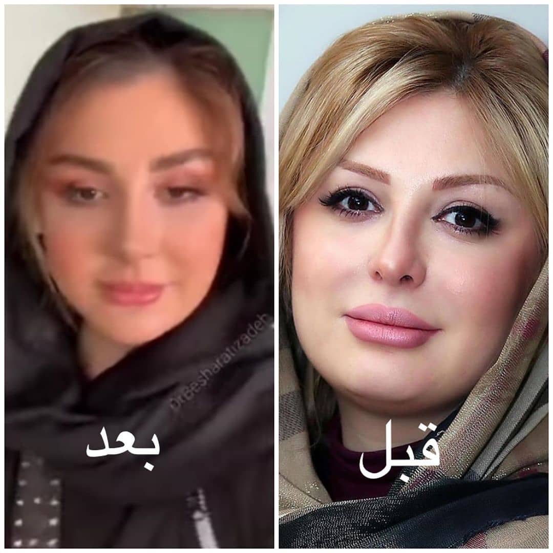 عمل بینی نیوشا ضیغمی و مدل جراحی او 