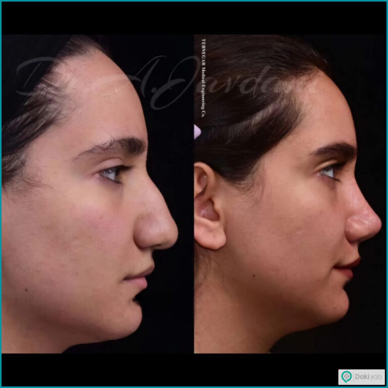 تصاویر بینی‌های عمل شده با نتیجه عالی