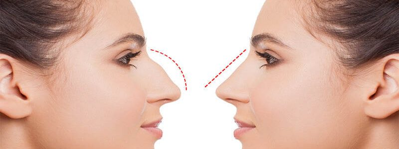 تصاویر عمل بینی استخوانی با مدل طبیعی