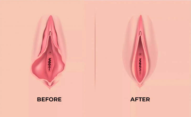 تصاویر لابیاپلاستی تصاویر لابیاپلاستی