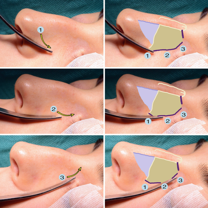 تصاویر مرحله به مرحله عمل بینی