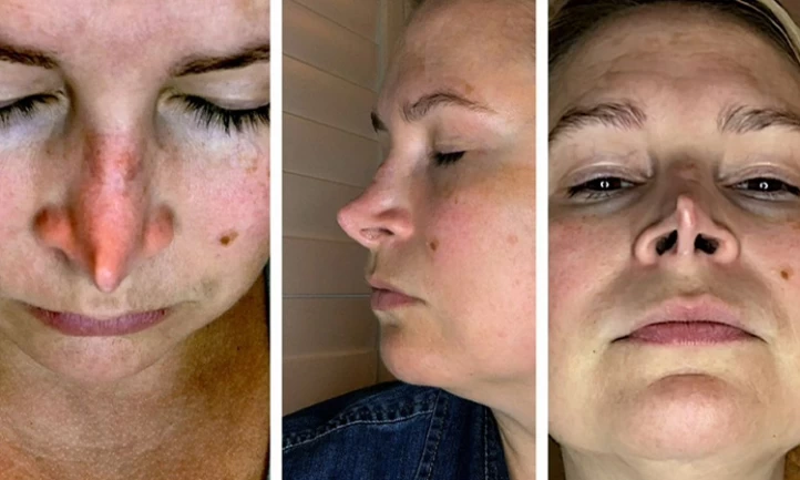 تصاویر نتایج ناموفق و زشت عمل بینی