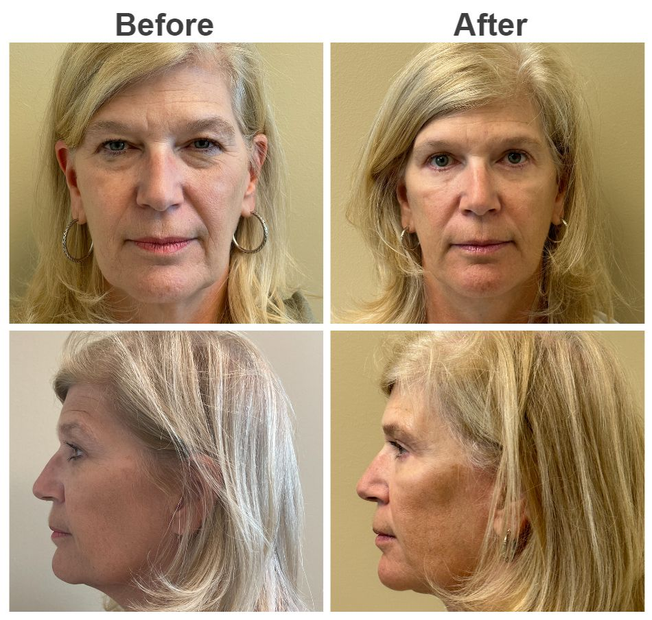 جراحی جوانسازی صورت