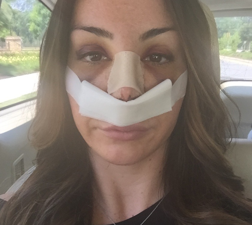 ظاهر بینی و کبودی‌ها یک روز پس از جراحی