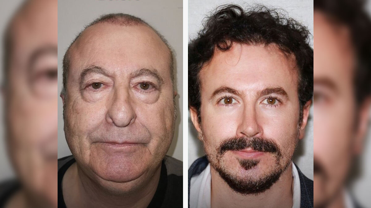 عکس جراحی زیبایی صورت