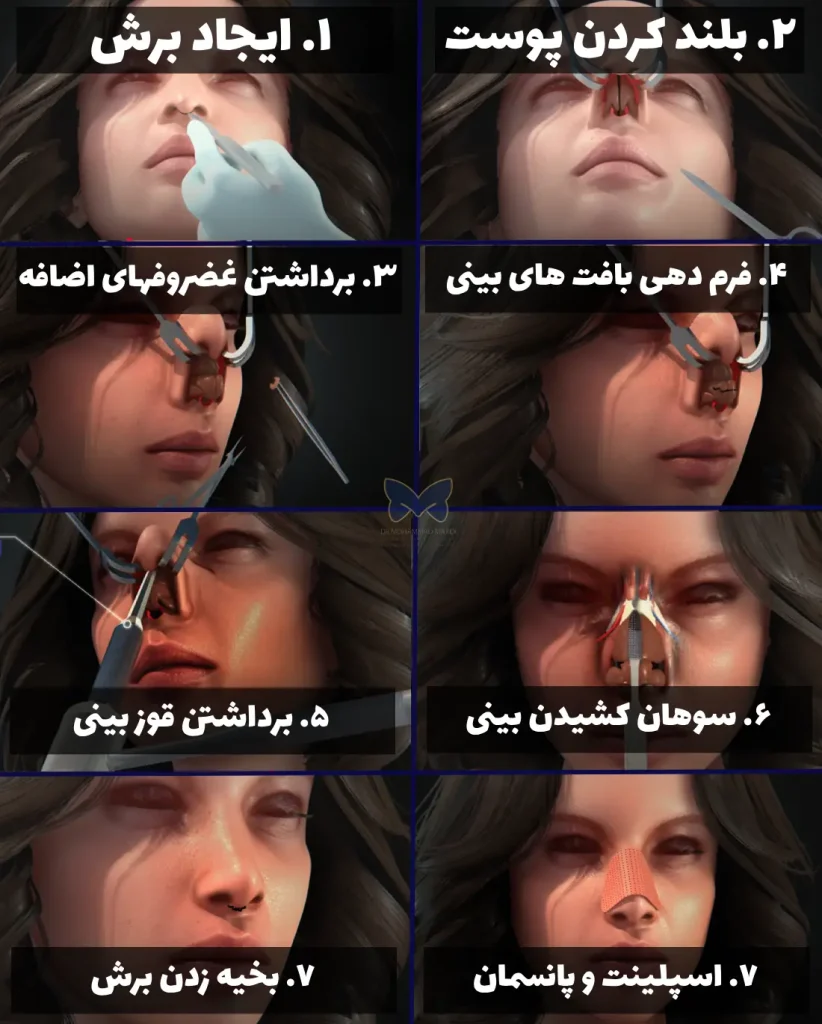 عکس مراحل انجام جراحی بینی