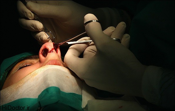 عکس‌های واقعی از جراحی بینی در اتاق عمل