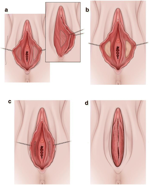 فتوگرافی لابیاپلاستی فتوگرافی لابیاپلاستی