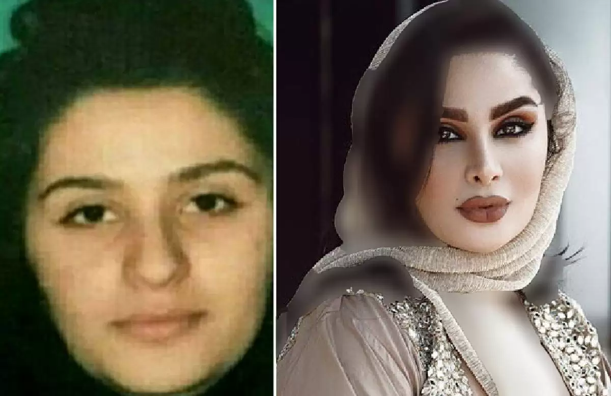 مقایسه دنیا جهانبخت قبل و بعد از عمل مقایسه دنیا جهانبخت قبل و بعد از عمل