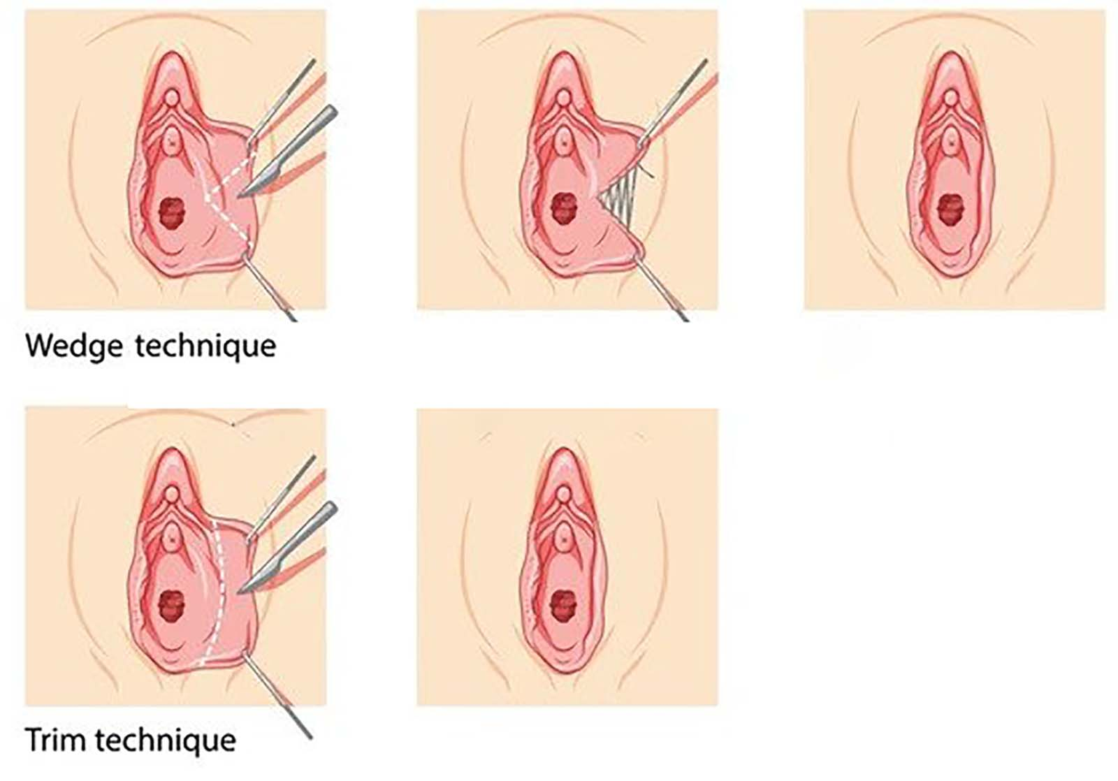 نماهای پس از پروسه پلاستیک واژن نماهای پس از پروسه پلاستیک واژن