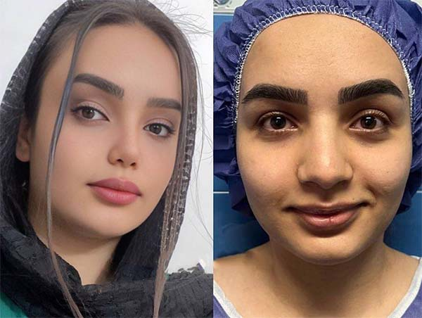 نمونه تصاویر عمل بینی مدل عروسکی