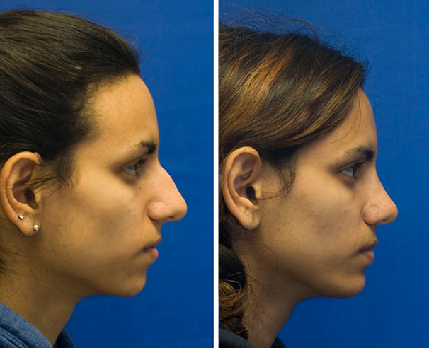 نمونه تصاویر عمل بینی